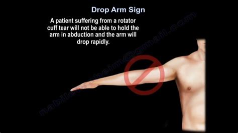 rotator cuff tests drop arm|positive hornblower's sign.